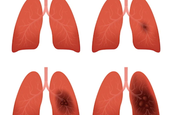 Lung Cancer Stages 400