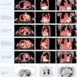 This figure shows fused I-124 evuzamitide positron emission tomography (PET)/computed tomography (CT) images from patients without amyloidosis and from patients with ATTR cardiac amyloidosis, early ATTR cardiac amyloidosis, light chain cardiac amyloidosis, gelsolin-mediated amyloidosis, and systemic organ amyloid. The columns represent radiological transaxial, sagittal, and coronal views except for the last row middle and far right columns, which are coronal projections. The blue asterisks represent physiological activity (tracer activity in the stomach and esophagus). The arrowheads represent pathological uptake. Note the small amount of cardiac uptake in the basal septum and the basal lateral walls (likely early ATTR cardiac amyloidosis), splenic uptake and pleural uptake in light chain amyloidosis, and cardiac and kidney uptake in gelsolin-mediated amyloidosis. The bright yellow color represents more tracer uptake.