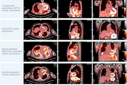 This figure shows fused I-124 evuzamitide positron emission tomography (PET)/computed tomography (CT) images from patients without amyloidosis and from patients with ATTR cardiac amyloidosis, early ATTR cardiac amyloidosis, light chain cardiac amyloidosis, gelsolin-mediated amyloidosis, and systemic organ amyloid. The columns represent radiological transaxial, sagittal, and coronal views except for the last row middle and far right columns, which are coronal projections. The blue asterisks represent physiological activity (tracer activity in the stomach and esophagus). The arrowheads represent pathological uptake. Note the small amount of cardiac uptake in the basal septum and the basal lateral walls (likely early ATTR cardiac amyloidosis), splenic uptake and pleural uptake in light chain amyloidosis, and cardiac and kidney uptake in gelsolin-mediated amyloidosis. The bright yellow color represents more tracer uptake.