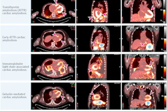 This figure shows fused I-124 evuzamitide positron emission tomography (PET)/computed tomography (CT) images from patients without amyloidosis and from patients with ATTR cardiac amyloidosis, early ATTR cardiac amyloidosis, light chain cardiac amyloidosis, gelsolin-mediated amyloidosis, and systemic organ amyloid. The columns represent radiological transaxial, sagittal, and coronal views except for the last row middle and far right columns, which are coronal projections. The blue asterisks represent physiological activity (tracer activity in the stomach and esophagus). The arrowheads represent pathological uptake. Note the small amount of cardiac uptake in the basal septum and the basal lateral walls (likely early ATTR cardiac amyloidosis), splenic uptake and pleural uptake in light chain amyloidosis, and cardiac and kidney uptake in gelsolin-mediated amyloidosis. The bright yellow color represents more tracer uptake.
