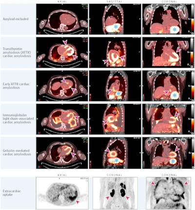 This figure shows fused I-124 evuzamitide positron emission tomography (PET)/computed tomography (CT) images from patients without amyloidosis and from patients with ATTR cardiac amyloidosis, early ATTR cardiac amyloidosis, light chain cardiac amyloidosis, gelsolin-mediated amyloidosis, and systemic organ amyloid. The columns represent radiological transaxial, sagittal, and coronal views except for the last row middle and far right columns, which are coronal projections. The blue asterisks represent physiological activity (tracer activity in the stomach and esophagus). The arrowheads represent pathological uptake. Note the small amount of cardiac uptake in the basal septum and the basal lateral walls (likely early ATTR cardiac amyloidosis), splenic uptake and pleural uptake in light chain amyloidosis, and cardiac and kidney uptake in gelsolin-mediated amyloidosis. The bright yellow color represents more tracer uptake.