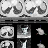 Example of AI-assisted pulmonary nodule detection and longitudinal volumetric assessment in a 65-year-old woman with peripheral arterial disease, a 24-pack-year smoking history, emphysema, and a family history of lung cancer. An incidental 8.5-mm right lower lobe pulmonary nodule is identified at CT angiography of the abdomen in July 2022 but does not receive follow-up. Subsequent imaging demonstrates interval growth, and CT-guided biopsy confirms stage IA lung adenocarcinoma. Contrast-enhanced axial chest CT images obtained on February 2, 2024, before robotic-assisted thoracoscopic segmentectomy, show a 12.1-mm spiculated right lower lobe pulmonary nodule. (A) Conventional contrast-enhanced axial chest CT image without AI assistance shows a 12.1-mm spiculated right lower lobe pulmonary nodule. (B) Corresponding CT image with AI-assisted pulmonary nodule detection, automated segmentation, and quantitative nodule assessment identifies a solid pulmonary nodule (nodule #1) measuring 13 × 8 (11) mm, with a volume of 739 mm3, a 45% volumetric increase compared with the previous contrast-enhanced chest CT performed on October 9, 2023 (510 mm3), and an estimated volume doubling time (VDT) of 216 days. (C) AI-generated longitudinal nodule analysis displays automated segmentation of the current (February 2, 2024) and previous (October 9, 2023) CT examinations, 3D nodule reconstruction, and quantitative volumetric assessment for longitudinal follow-up. The AI interface is displayed in the original software language (Dutch).