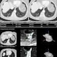 Example of AI-assisted pulmonary nodule detection and longitudinal volumetric assessment in a 65-year-old woman with peripheral arterial disease, a 24-pack-year smoking history, emphysema, and a family history of lung cancer. An incidental 8.5-mm right lower lobe pulmonary nodule is identified at CT angiography of the abdomen in July 2022 but does not receive follow-up. Subsequent imaging demonstrates interval growth, and CT-guided biopsy confirms stage IA lung adenocarcinoma. Contrast-enhanced axial chest CT images obtained on February 2, 2024, before robotic-assisted thoracoscopic segmentectomy, show a 12.1-mm spiculated right lower lobe pulmonary nodule. (A) Conventional contrast-enhanced axial chest CT image without AI assistance shows a 12.1-mm spiculated right lower lobe pulmonary nodule. (B) Corresponding CT image with AI-assisted pulmonary nodule detection, automated segmentation, and quantitative nodule assessment identifies a solid pulmonary nodule (nodule #1) measuring 13 × 8 (11) mm, with a volume of 739 mm3, a 45% volumetric increase compared with the previous contrast-enhanced chest CT performed on October 9, 2023 (510 mm3), and an estimated volume doubling time (VDT) of 216 days. (C) AI-generated longitudinal nodule analysis displays automated segmentation of the current (February 2, 2024) and previous (October 9, 2023) CT examinations, 3D nodule reconstruction, and quantitative volumetric assessment for longitudinal follow-up. The AI interface is displayed in the original software language (Dutch).