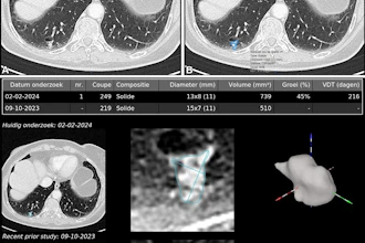 Example of AI-assisted pulmonary nodule detection and longitudinal volumetric assessment in a 65-year-old woman with peripheral arterial disease, a 24-pack-year smoking history, emphysema, and a family history of lung cancer. An incidental 8.5-mm right lower lobe pulmonary nodule is identified at CT angiography of the abdomen in July 2022 but does not receive follow-up. Subsequent imaging demonstrates interval growth, and CT-guided biopsy confirms stage IA lung adenocarcinoma. Contrast-enhanced axial chest CT images obtained on February 2, 2024, before robotic-assisted thoracoscopic segmentectomy, show a 12.1-mm spiculated right lower lobe pulmonary nodule. (A) Conventional contrast-enhanced axial chest CT image without AI assistance shows a 12.1-mm spiculated right lower lobe pulmonary nodule. (B) Corresponding CT image with AI-assisted pulmonary nodule detection, automated segmentation, and quantitative nodule assessment identifies a solid pulmonary nodule (nodule #1) measuring 13 × 8 (11) mm, with a volume of 739 mm3, a 45% volumetric increase compared with the previous contrast-enhanced chest CT performed on October 9, 2023 (510 mm3), and an estimated volume doubling time (VDT) of 216 days. (C) AI-generated longitudinal nodule analysis displays automated segmentation of the current (February 2, 2024) and previous (October 9, 2023) CT examinations, 3D nodule reconstruction, and quantitative volumetric assessment for longitudinal follow-up. The AI interface is displayed in the original software language (Dutch).