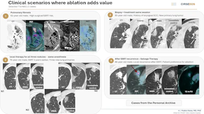 Clinical cases presented by Dr. Publio Viana show the role of lung ablation in patients with pulmonary fibrosis, during same-session biopsy and treatment, and after SBRT recurrence.