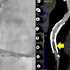 Photon-counting CT correctly identified ≥50% in-stent restenosis in the mid-right coronary artery, which was confirmed by invasive angiography.