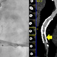 Photon-counting CT correctly identified ≥50% in-stent restenosis in the mid-right coronary artery, which was confirmed by invasive angiography.