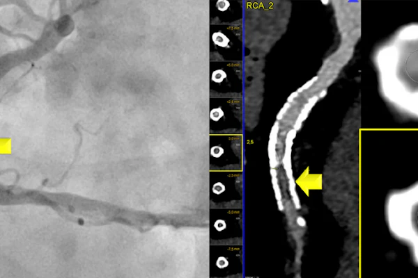 Photon-counting CT correctly identified ≥50% in-stent restenosis in the mid-right coronary artery, which was confirmed by invasive angiography.