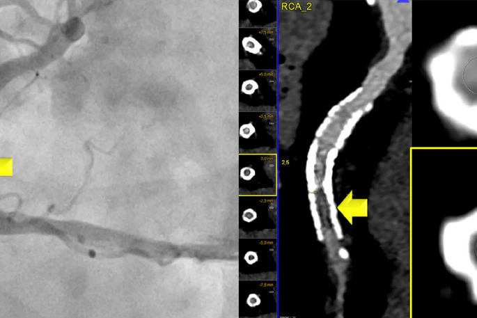 Photon-counting CT correctly identified ≥50% in-stent restenosis in the mid-right coronary artery, which was confirmed by invasive angiography.