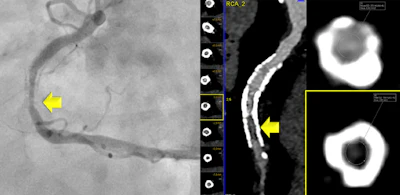 Photon-counting CT correctly identified ≥50% in-stent restenosis in the mid-right coronary artery, which was confirmed by invasive angiography.