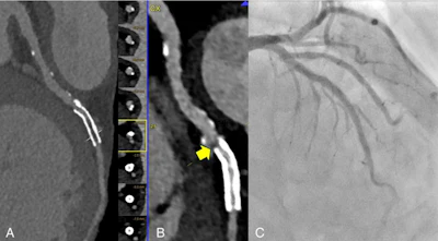Photon-counting CT suggested ≥50% in-stent restenosis because of artifacts, but invasive angiography showed no true restenosis.