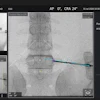 Image Vuze Spinal Surgery Guidance Software