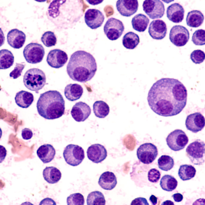 Multiple Myeloma 400