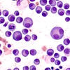 Multiple Myeloma 400