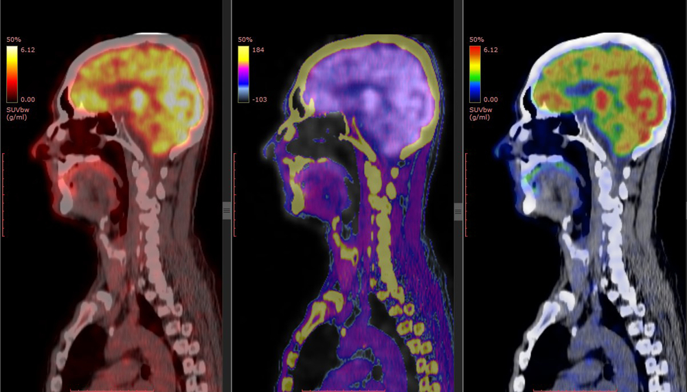 Brain PET/CT imaging is one of the diagnostic applications of nuclear medicine.