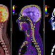 Brain PET/CT imaging is one of the diagnostic applications of nuclear medicine.