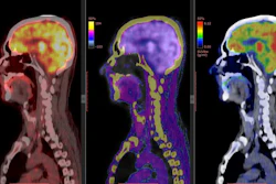 Brain PET/CT imaging is one of the diagnostic applications of nuclear medicine.