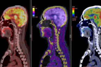 Brain PET/CT imaging is one of the diagnostic applications of nuclear medicine.