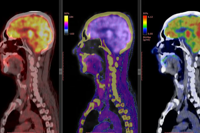 Brain PET/CT imaging is one of the diagnostic applications of nuclear medicine.