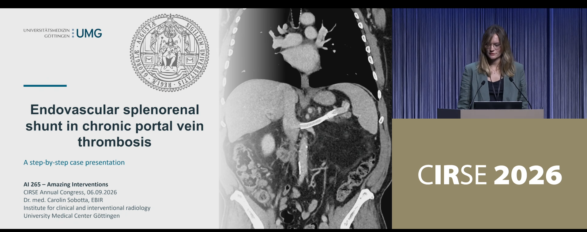 Endovascular splenorenal shunt in chronic portal vein thrombosis presented by Dr. Carolin Sobotta University Medicine Goettingen Goettingen, Germany