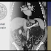 Endovascular splenorenal shunt in chronic portal vein thrombosis presented by Dr. Carolin Sobotta University Medicine Goettingen Goettingen, Germany