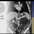 Endovascular splenorenal shunt in chronic portal vein thrombosis presented by Dr. Carolin Sobotta University Medicine Goettingen Goettingen, Germany