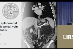 Endovascular splenorenal shunt in chronic portal vein thrombosis presented by Dr. Carolin Sobotta University Medicine Goettingen Goettingen, Germany