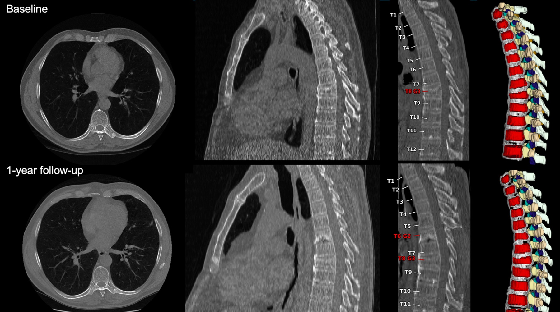 Baseline and 1-year follow-up CT and MRI scans of thoracic and lumbar spine with color-coded vertebral segmentation