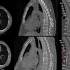 Baseline and 1-year follow-up CT and MRI scans of thoracic and lumbar spine with color-coded vertebral segmentation