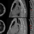 Baseline and 1-year follow-up CT and MRI scans of thoracic and lumbar spine with color-coded vertebral segmentation