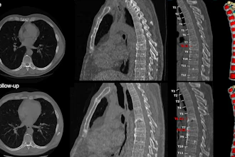Baseline and 1-year follow-up CT and MRI scans of thoracic and lumbar spine with color-coded vertebral segmentation