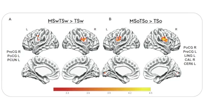 Brain fMRI activation maps showing statistical comparisons of temporal-spatial processing regions with color-coded intensity scales