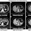Comparative abdominal CT scans showing six cross-sectional images with varying BMI and radiation dose measurements