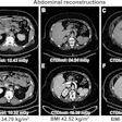 Comparative abdominal CT scans showing six cross-sectional images with varying BMI and radiation dose measurements