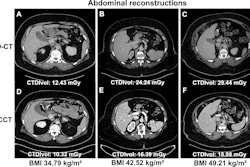 Comparative abdominal CT scans showing six cross-sectional images with varying BMI and radiation dose measurements