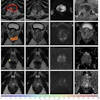 MRI brain scan grid showing axial slices with AI diagnostic analysis and suspicion score heatmap ranging from 0-100%