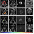 MRI brain scan grid showing axial slices with AI diagnostic analysis and suspicion score heatmap ranging from 0-100%