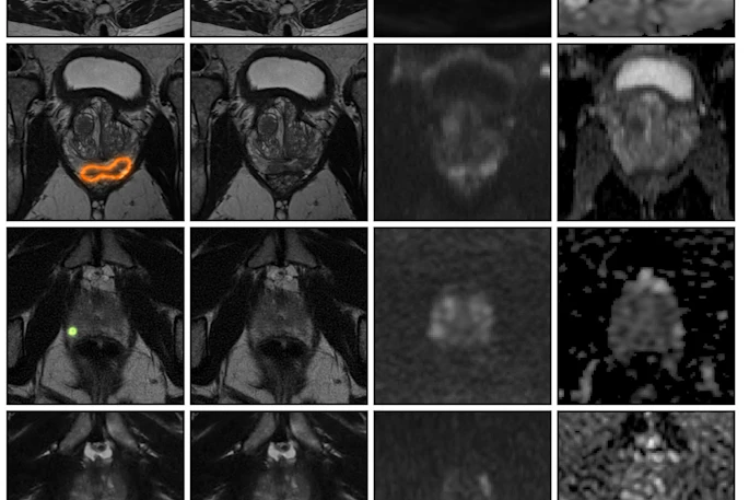 MRI brain scan grid showing axial slices with AI diagnostic analysis and suspicion score heatmap ranging from 0-100%