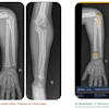 Forearm X-ray comparison showing initial ulna fracture and post-surgical fixation with intramedullary rod