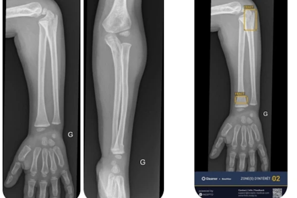 Forearm X-ray comparison showing initial ulna fracture and post-surgical fixation with intramedullary rod