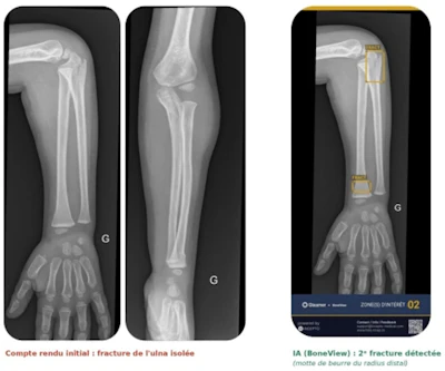 Forearm X-ray comparison showing initial ulna fracture and post-surgical fixation with intramedullary rod