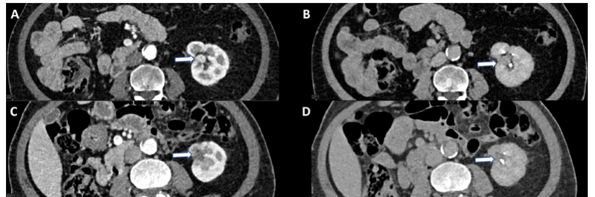 Four abdominal CT scan cross-sections showing internal organs and anatomical structures in grayscale medical imaging