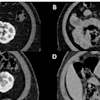 Four abdominal CT scan cross-sections showing internal organs and anatomical structures in grayscale medical imaging