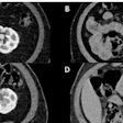Four abdominal CT scan cross-sections showing internal organs and anatomical structures in grayscale medical imaging