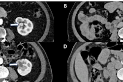 Four abdominal CT scan cross-sections showing internal organs and anatomical structures in grayscale medical imaging