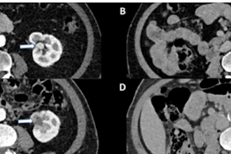 Four abdominal CT scan cross-sections showing internal organs and anatomical structures in grayscale medical imaging