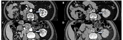 Four abdominal CT scan cross-sections showing internal organs and anatomical structures in grayscale medical imaging