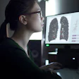 Medical professional reviewing lung CT scan images on multiple monitors in diagnostic workstation