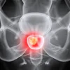 X-ray scan of pelvis with highlighted prostate gland in red for medical diagnosis