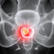 X-ray scan of pelvis with highlighted prostate gland in red for medical diagnosis
